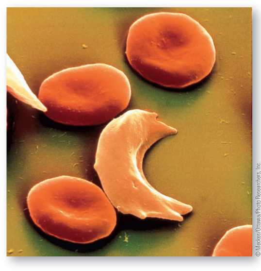 The Case of Sickle-Cell Anemia